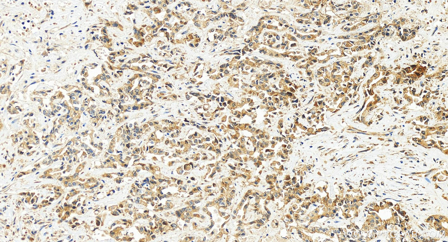 IHC staining of human intrahepatic cholangiocarcinoma using 55106-1-AP