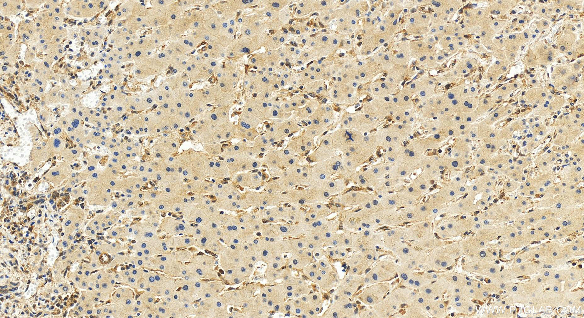 IHC staining of human intrahepatic cholangiocarcinoma using 51153-1-AP