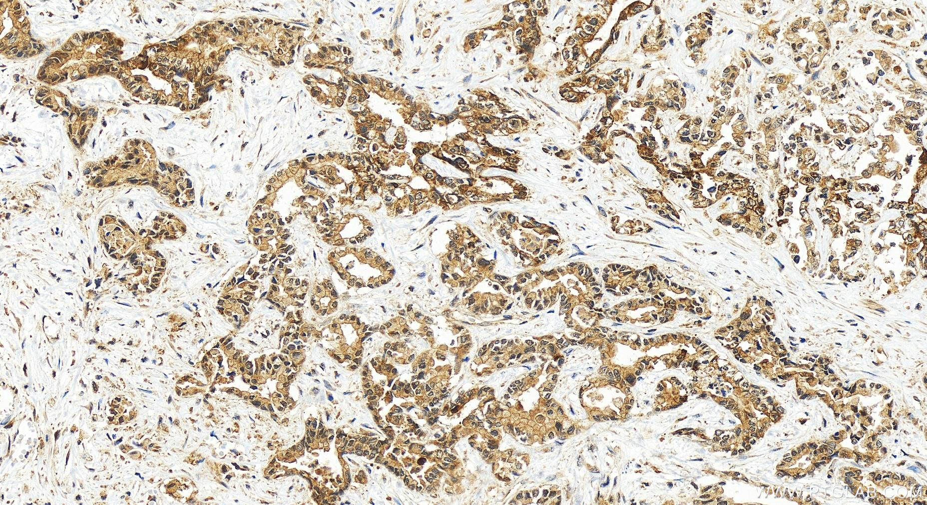 IHC staining of human intrahepatic cholangiocarcinoma using 51153-1-AP