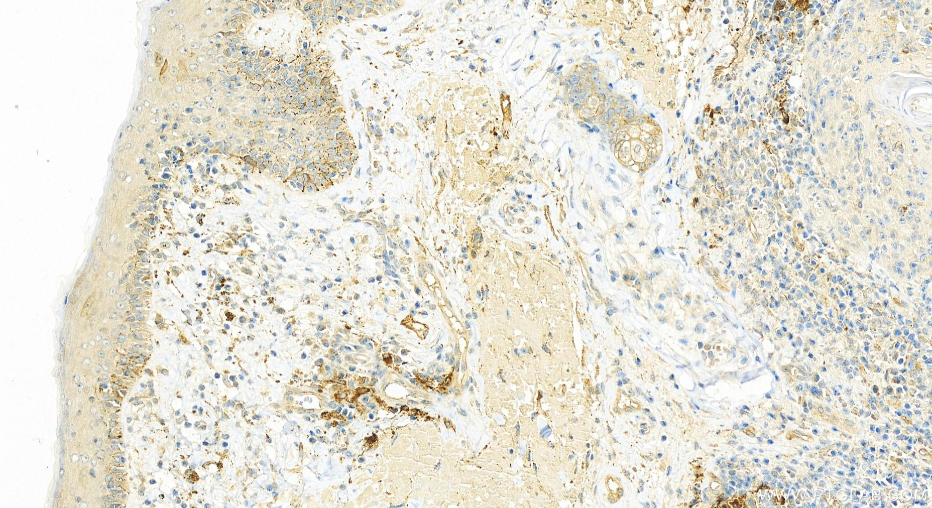 IHC staining of skin cancer using 14124-1-AP