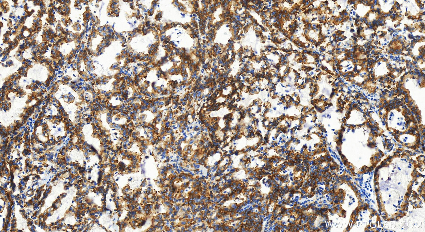 IHC staining of human stomach cancer using 83690-5-RR (same clone as 83690-5-PBS)