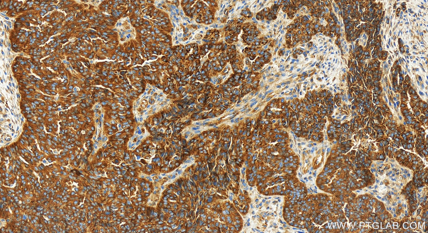 IHC staining of human ovarian cancer using 83690-5-RR (same clone as 83690-5-PBS)