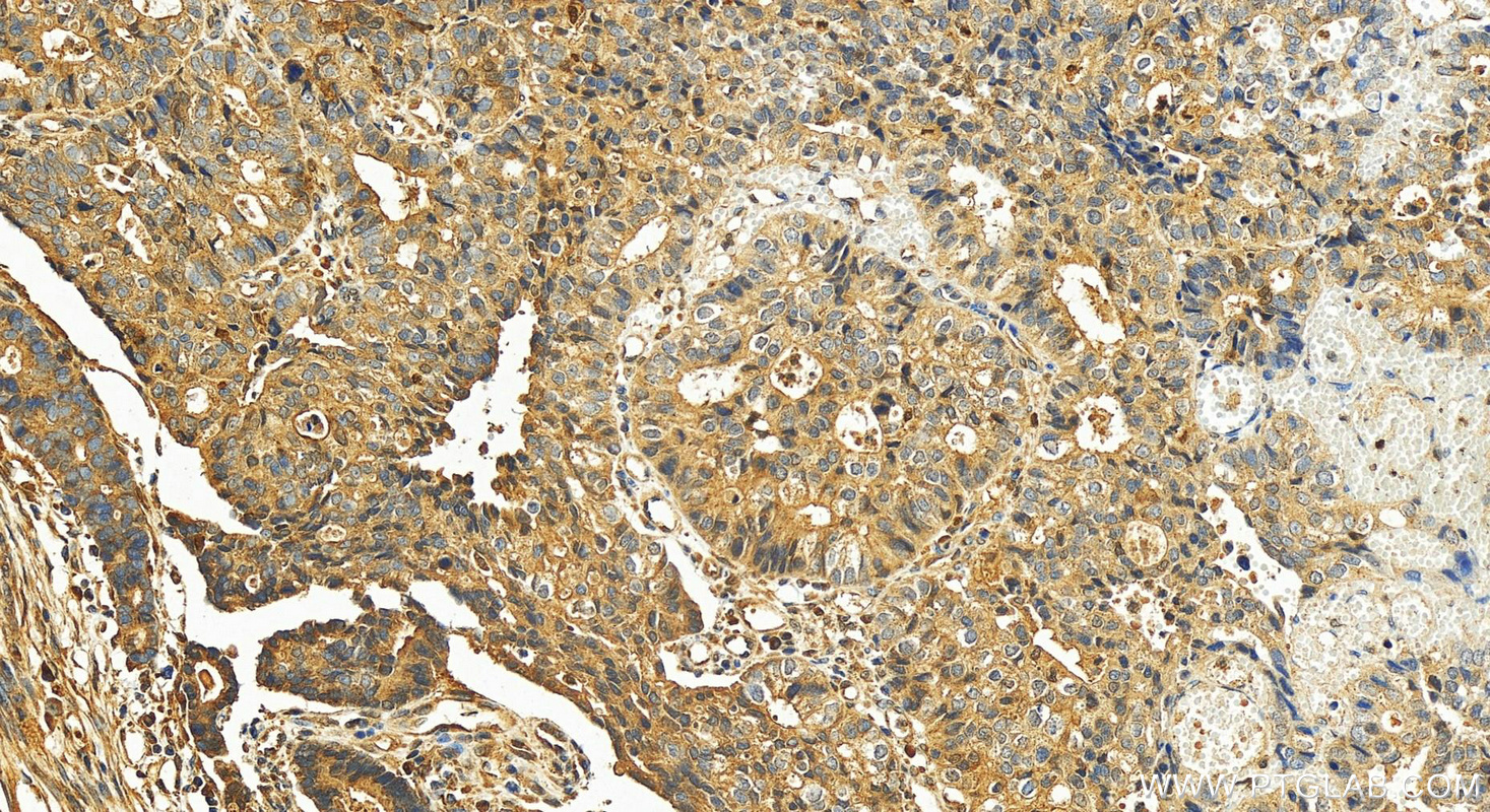 IHC staining of human stomach cancer using 25500-1-AP