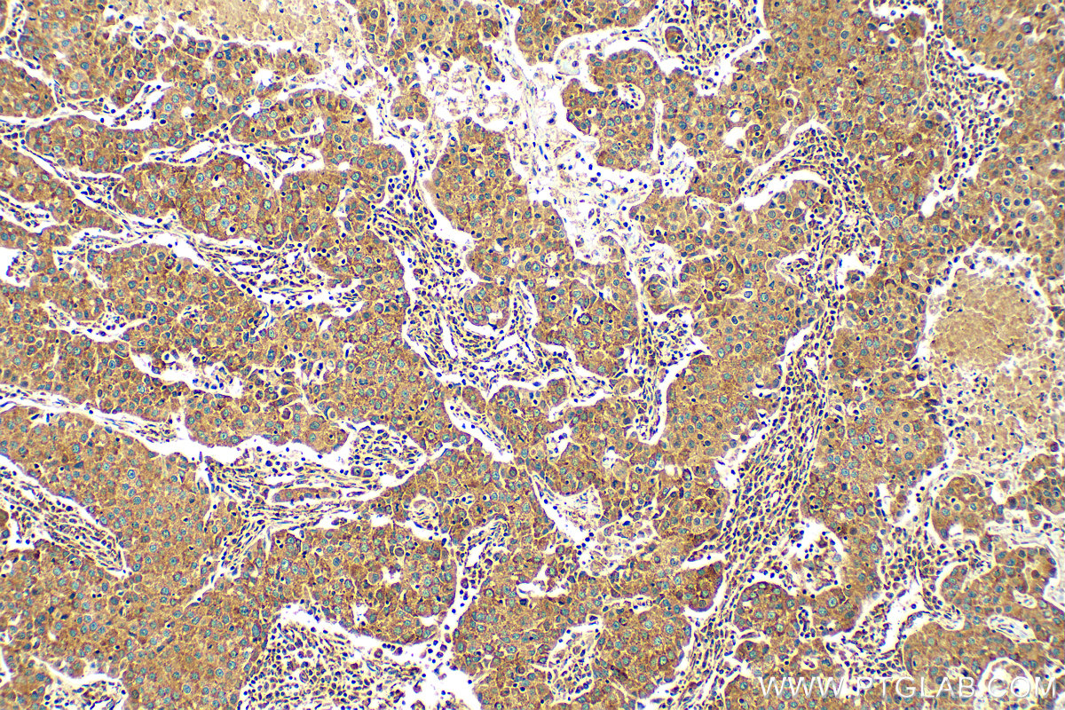 IHC staining of human breast cancer using 81910-1-RR (same clone as 81910-1-PBS)