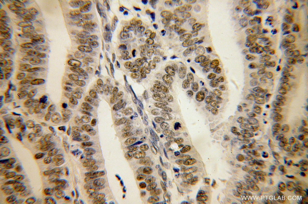 IHC staining of human endometrial cancer using 14258-1-AP (same clone as 14258-1-PBS)