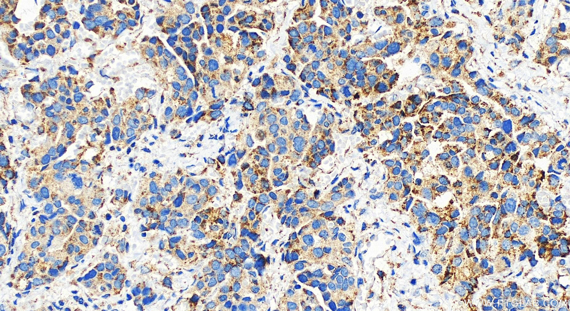 IHC staining of human ovary cancer using 30081-1-AP