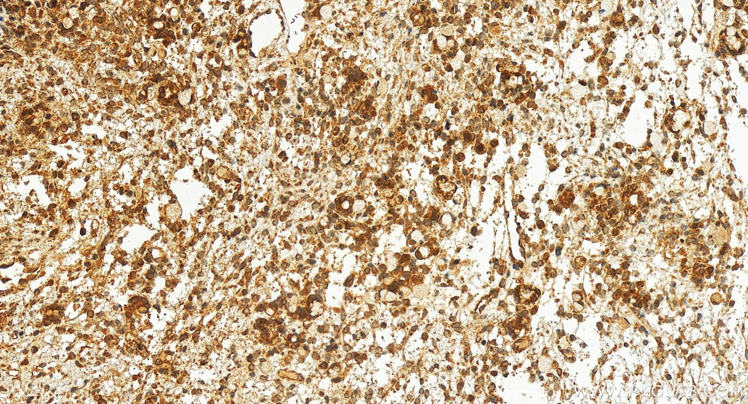 IHC staining of human ovary cancer using 16225-1-AP