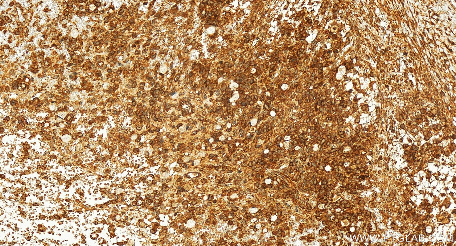 IHC staining of human ovary cancer using 16225-1-AP