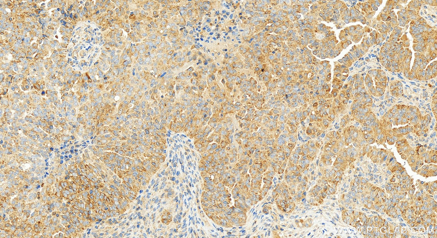 IHC staining of human ovarian  cancer using 82695-2-RR