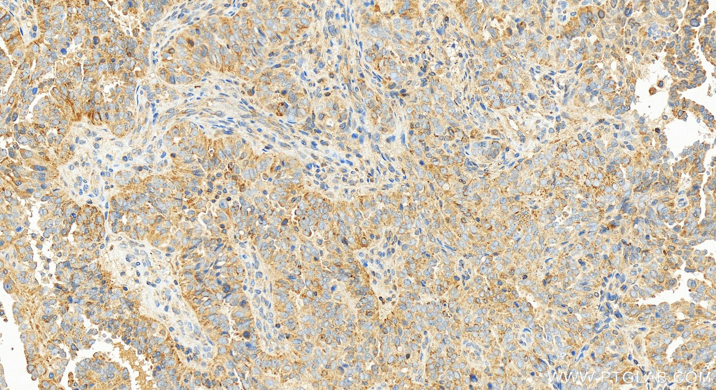 IHC staining of human ovarian  cancer using 82695-2-RR