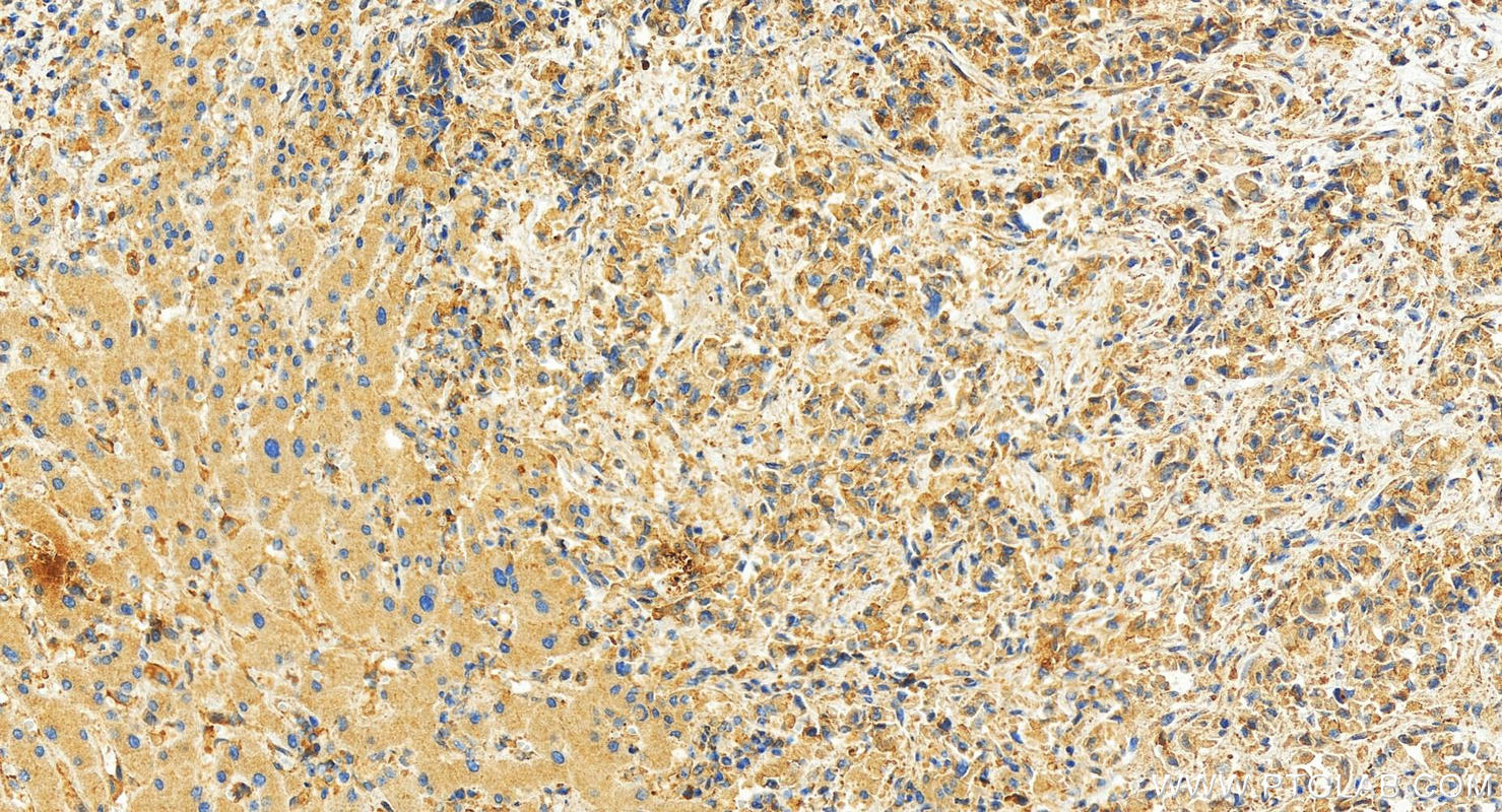 IHC staining of human intrahepatic cholangiocarcinoma using 82695-4-RR (same clone as 82695-4-PBS)