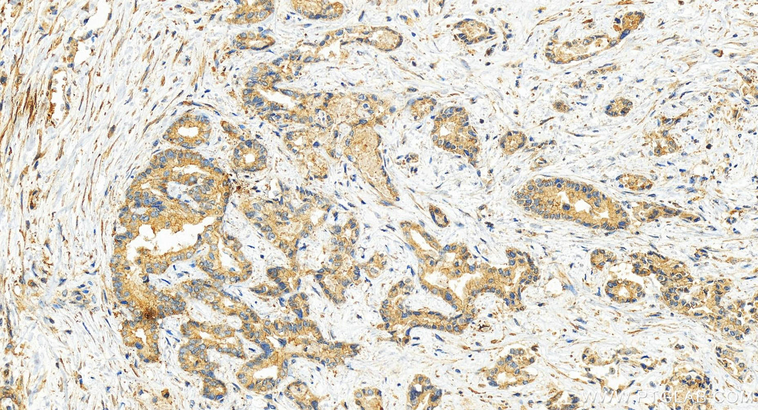 IHC staining of human intrahepatic cholangiocarcinoma using 82695-4-RR (same clone as 82695-4-PBS)