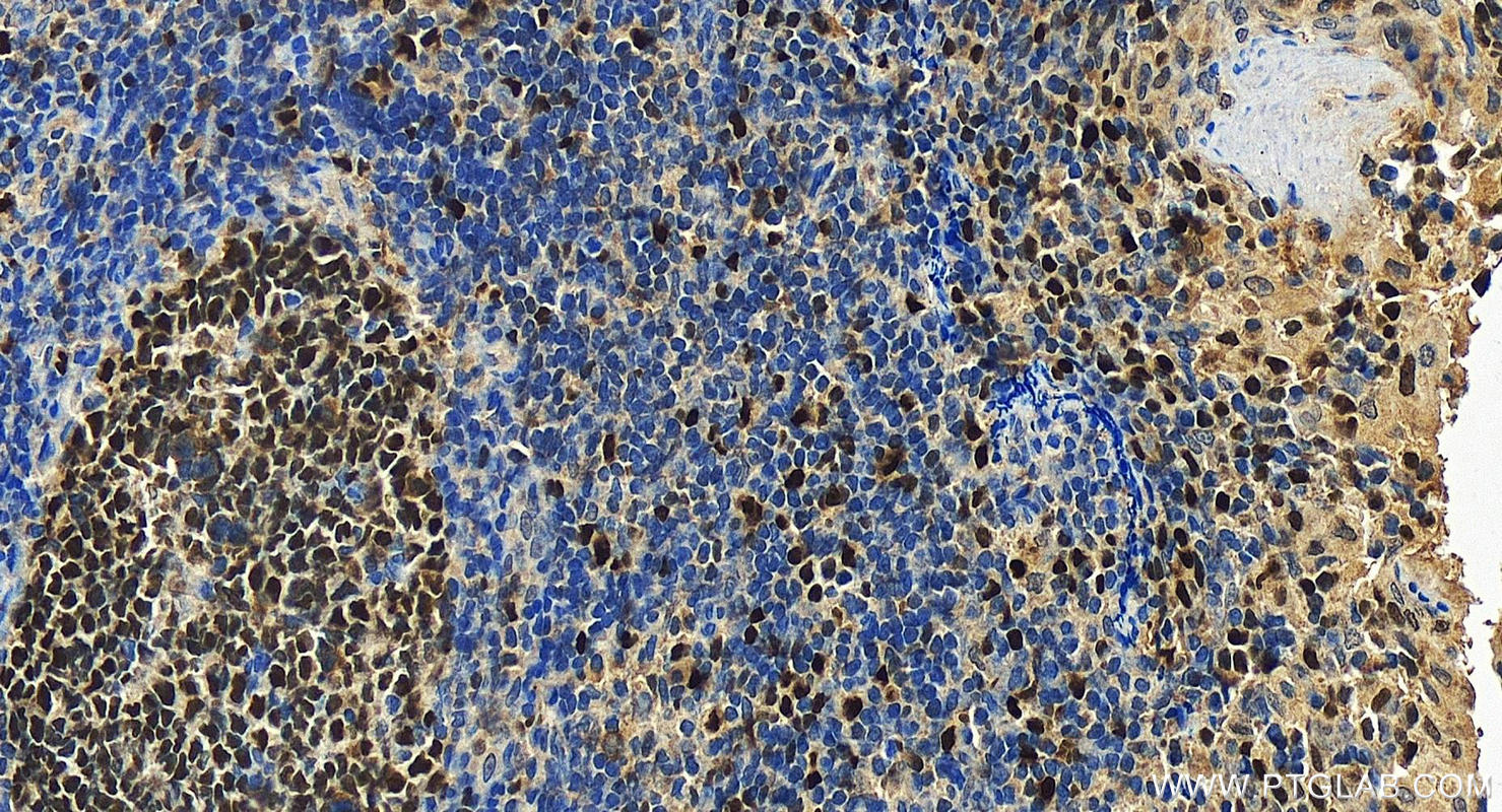 IHC staining of human tonsillitis using 10513-1-AP