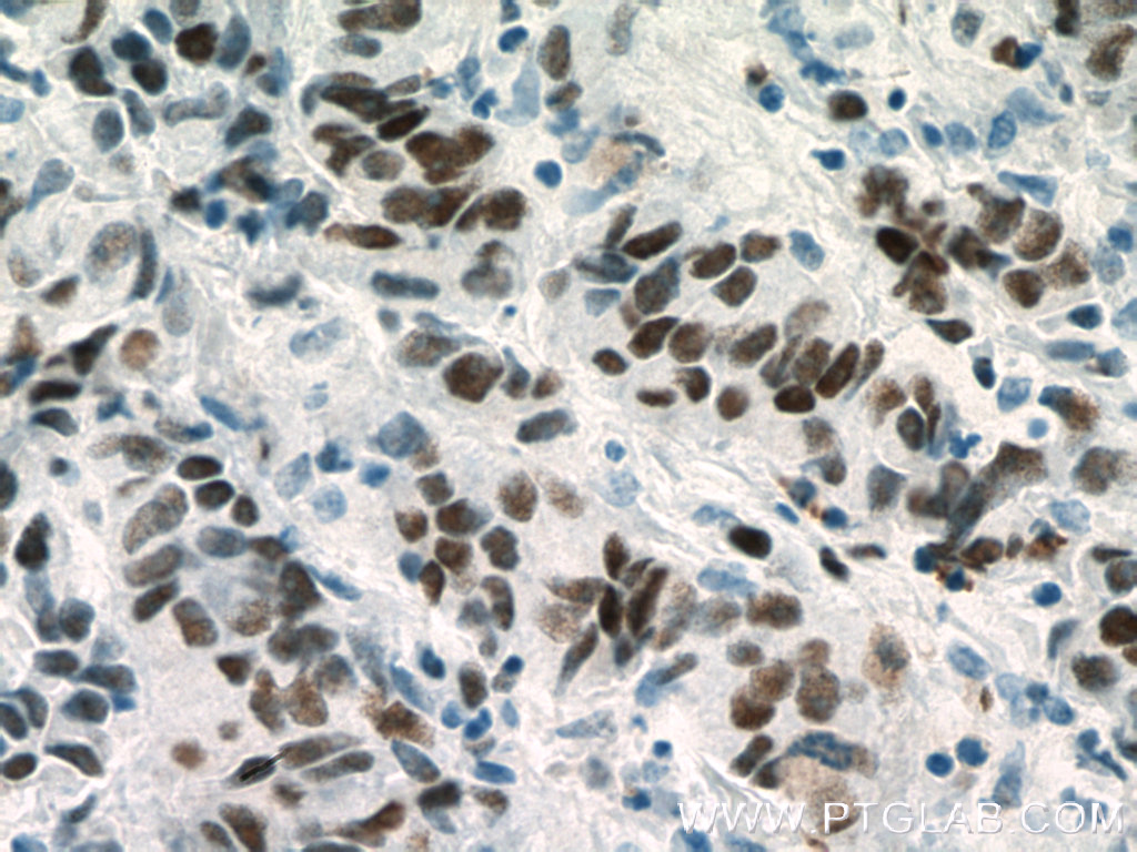 IHC staining of human prostate cancer using 66204-1-Ig (same clone as 66204-1-PBS)