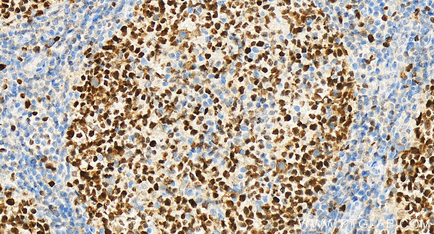 IHC staining of Human tonsillitis using 66204-1-Ig