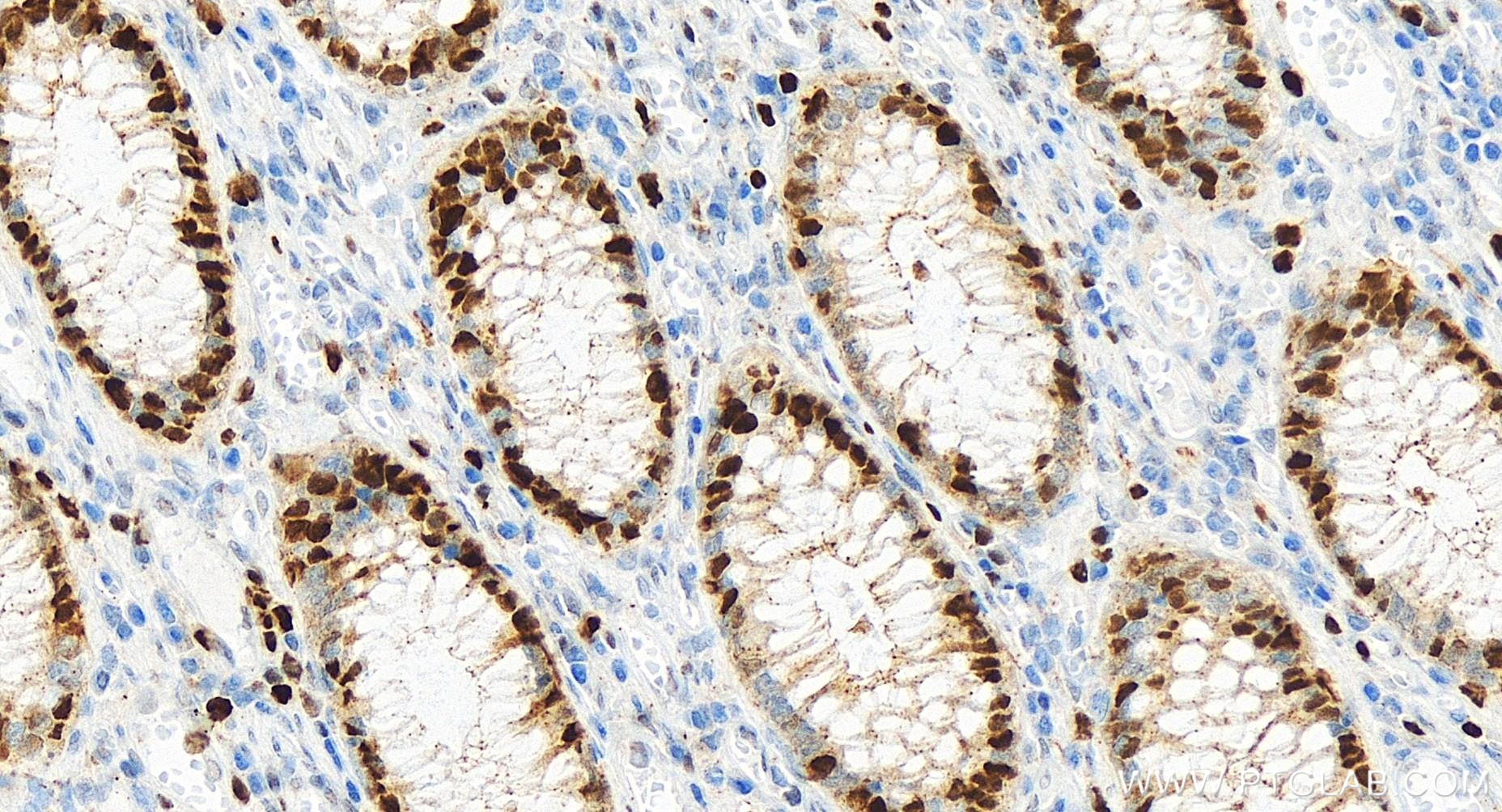 IHC staining of human colon cancer using 84792-5-RR (same clone as 84792-5-PBS)