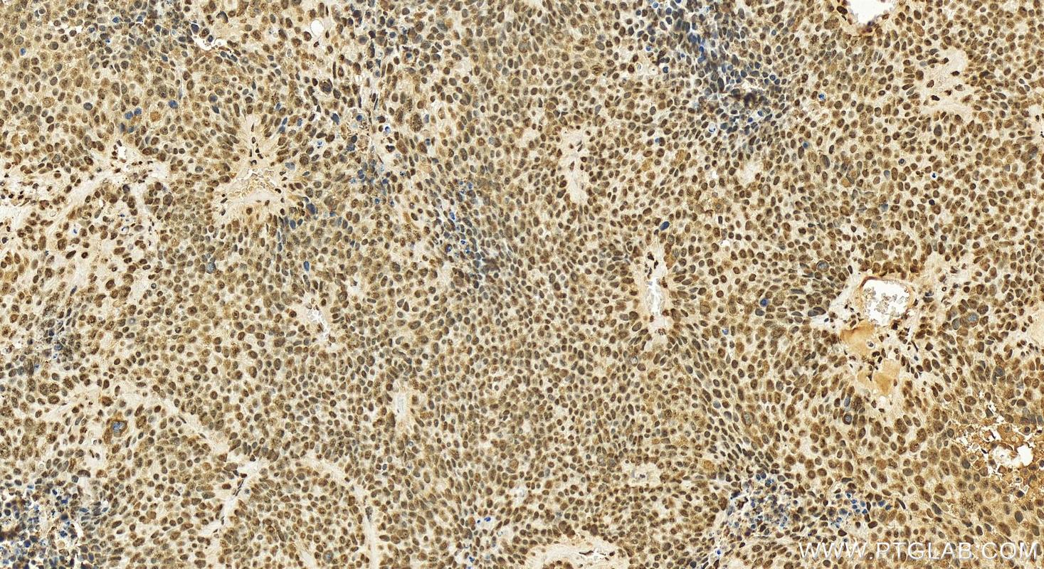 IHC staining of human lung squamous cell carcinoma using 13347-2-AP