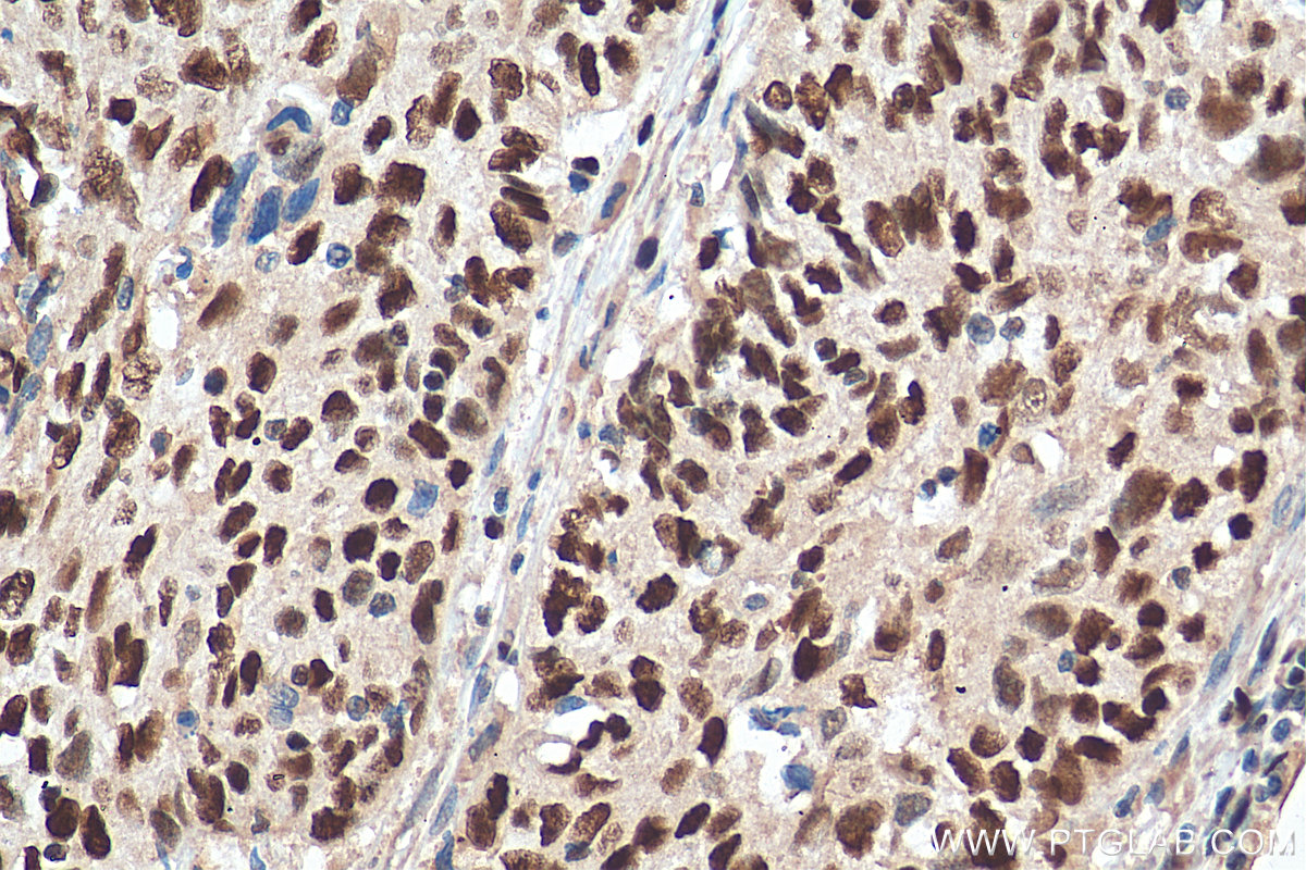 IHC staining of human cervical cancer using 67989-1-Ig (same clone as 67989-1-PBS)