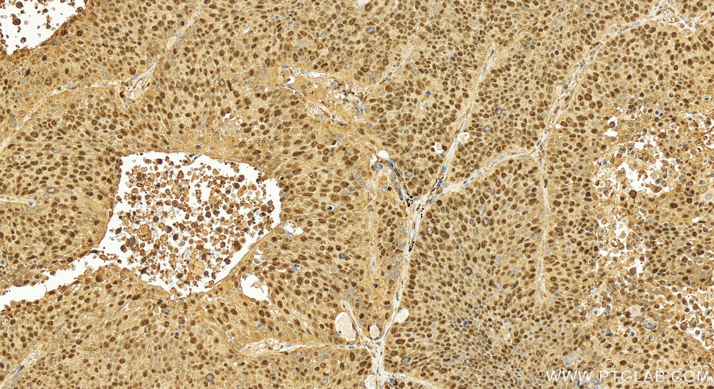 IHC staining of human lung squamous cell carcinoma using 11225-1-AP