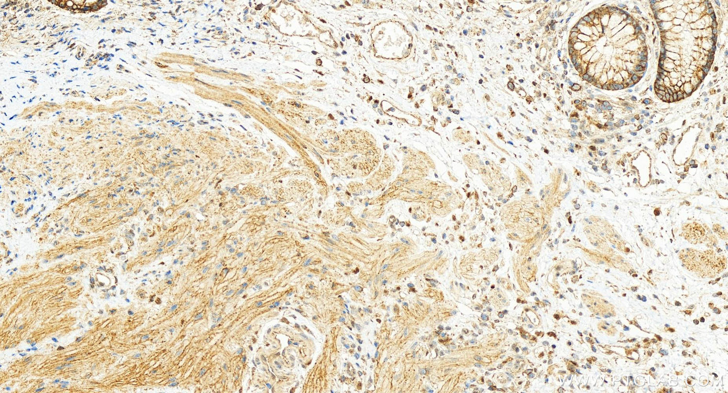 IHC staining of human colon cancer using 20139-1-AP