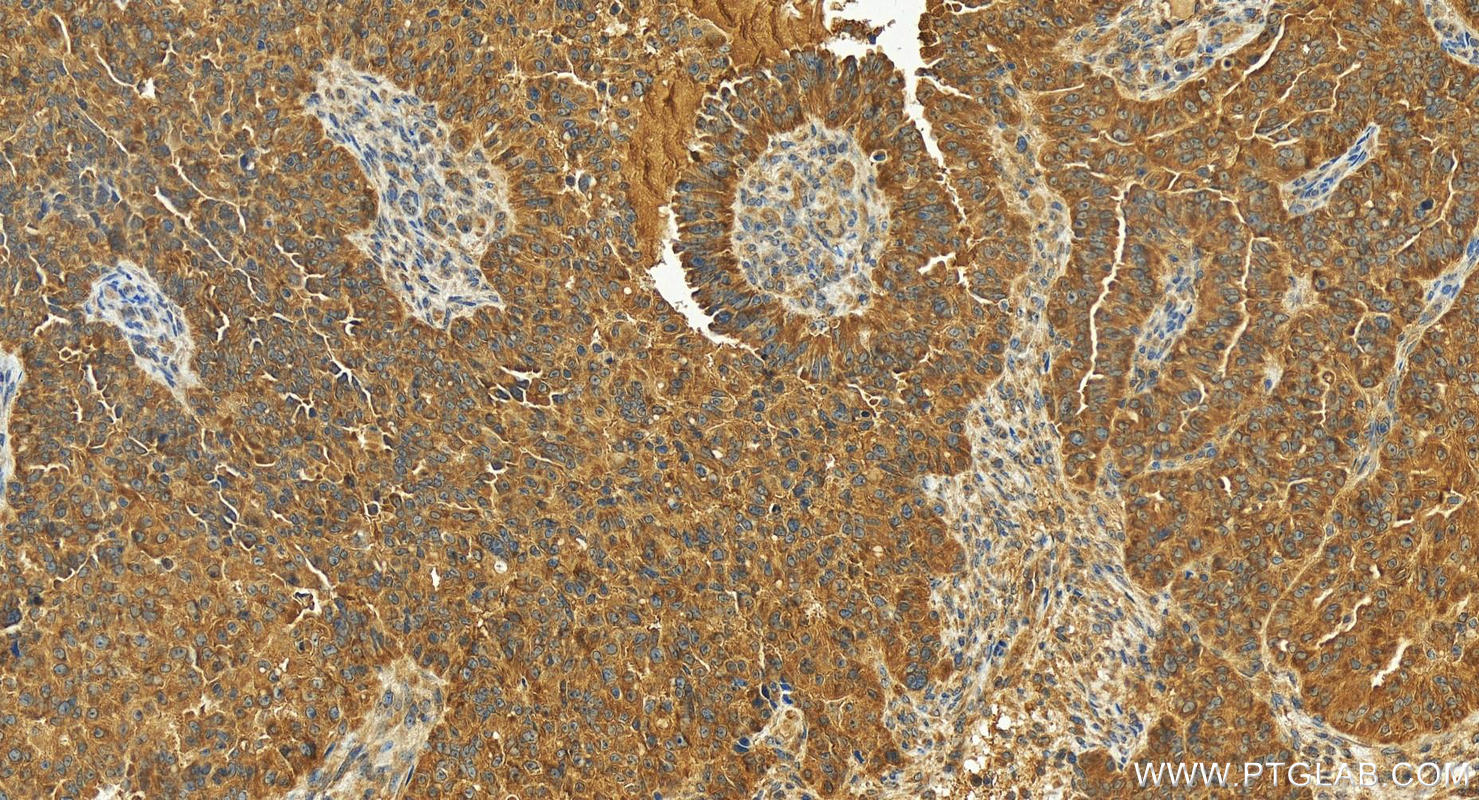 IHC staining of human ovarian  cancer using 14984-1-AP