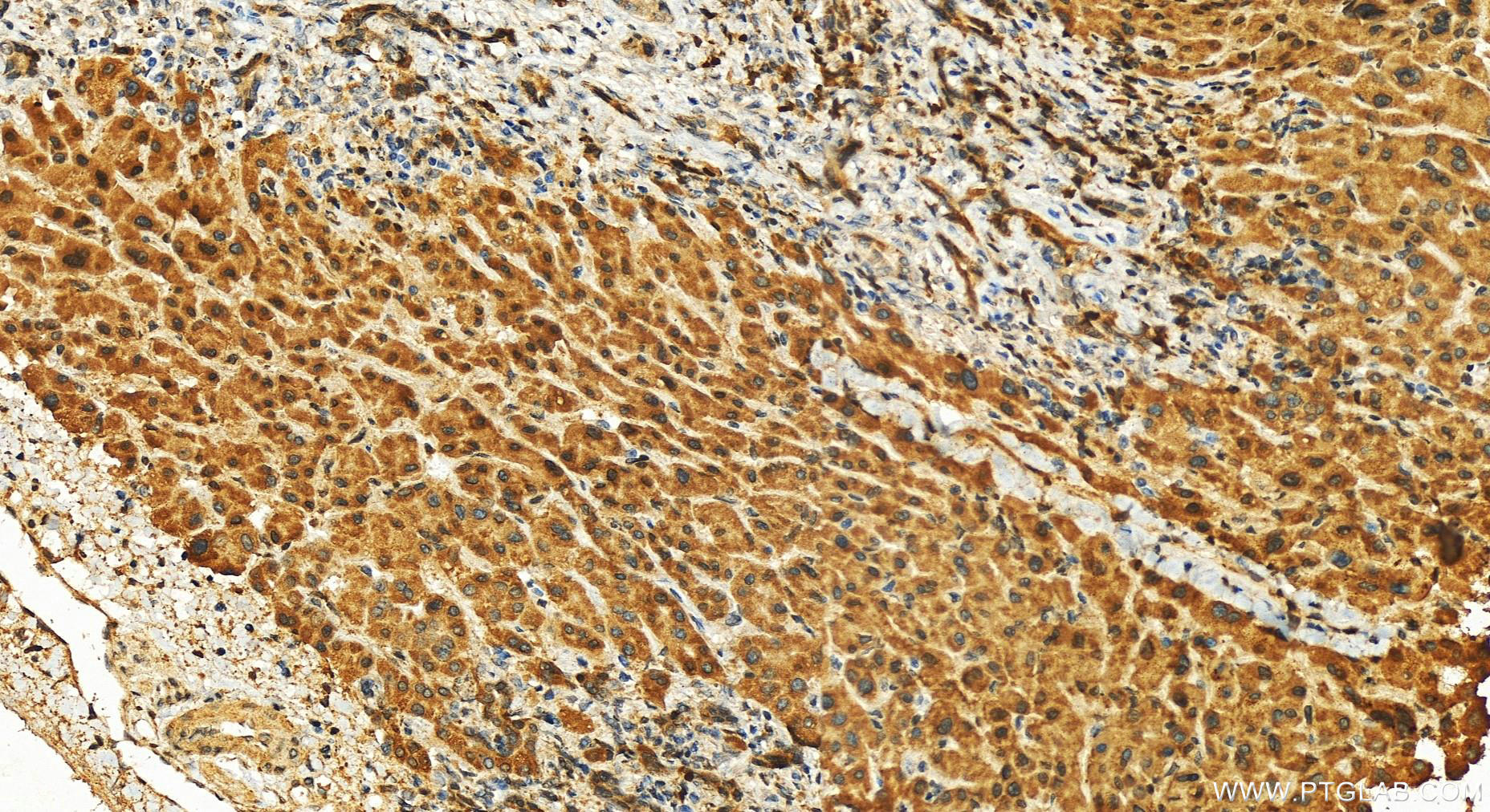 IHC staining of human intrahepatic cholangiocarcinoma using 11009-1-AP