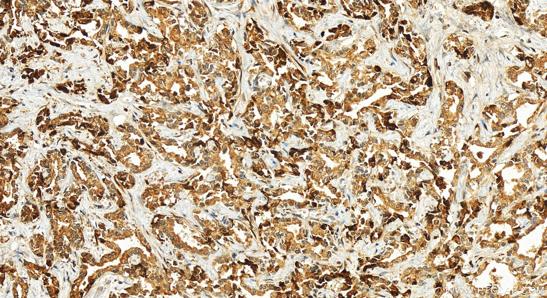 IHC staining of human intrahepatic cholangiocarcinoma using 11009-1-AP