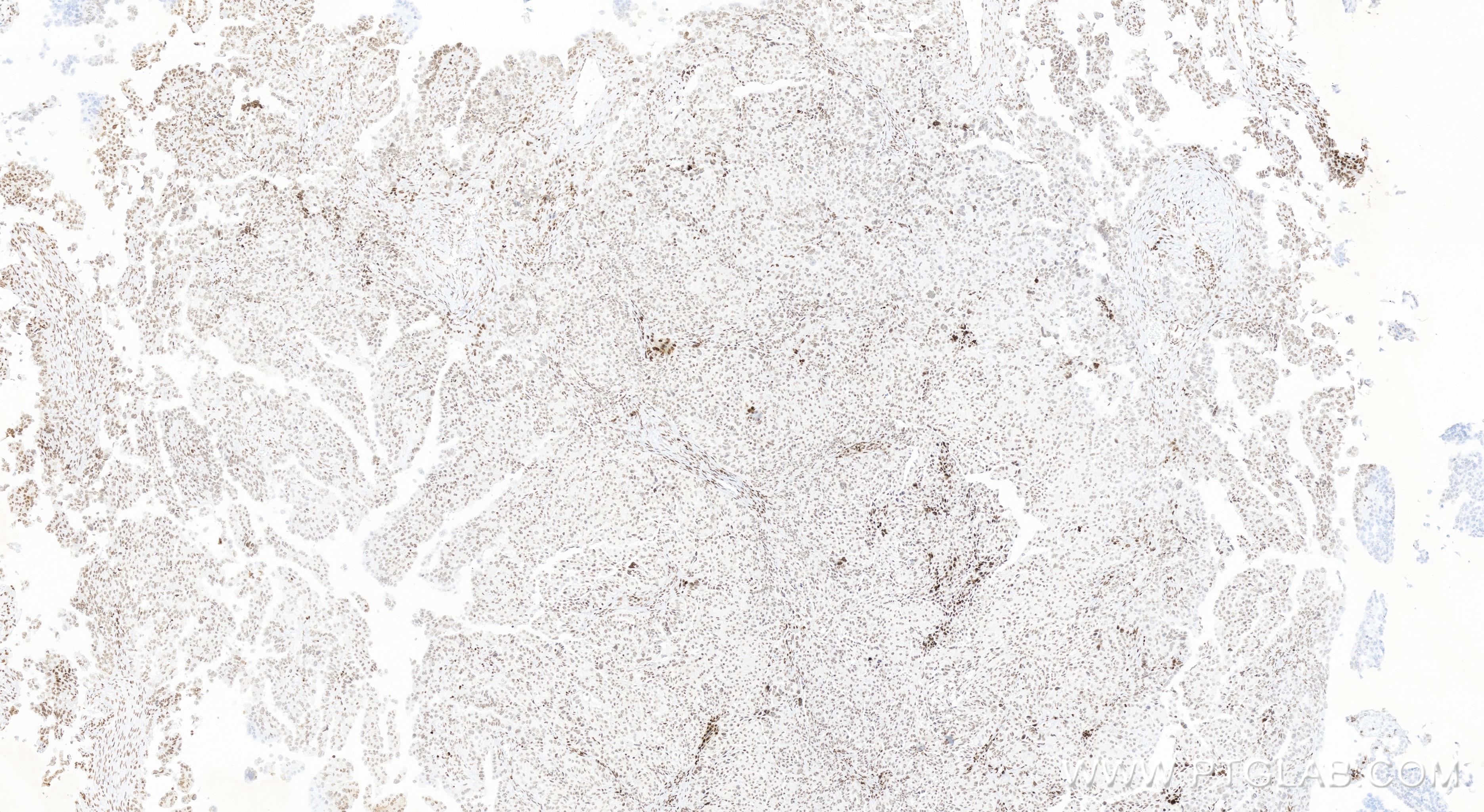 IHC staining of human ovary cancer using 84534-5-RR