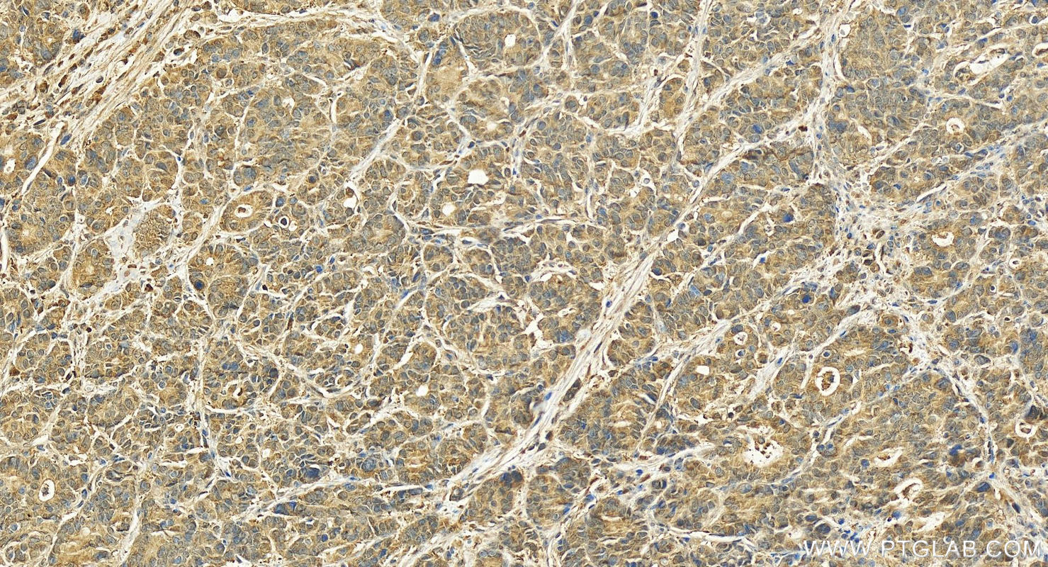 IHC staining of human stomach cancer using 15352-1-AP