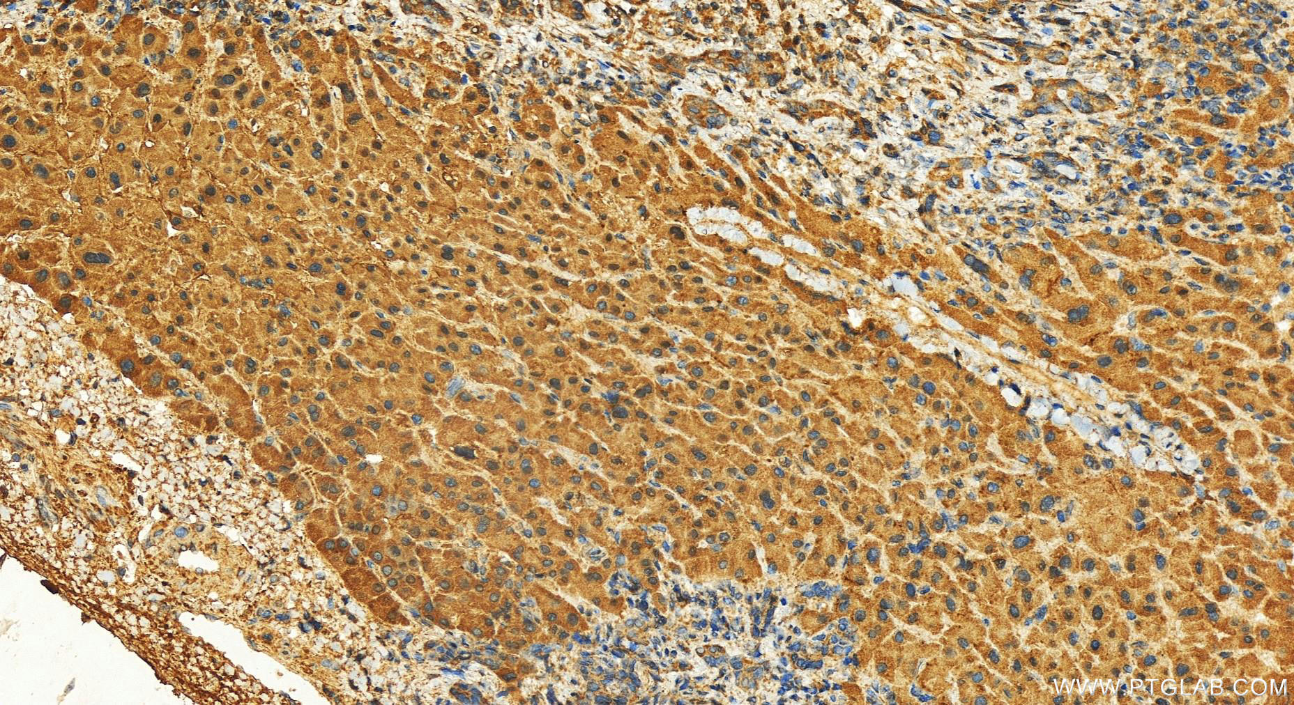 IHC staining of human intrahepatic cholangiocarcinoma using 14604-1-AP