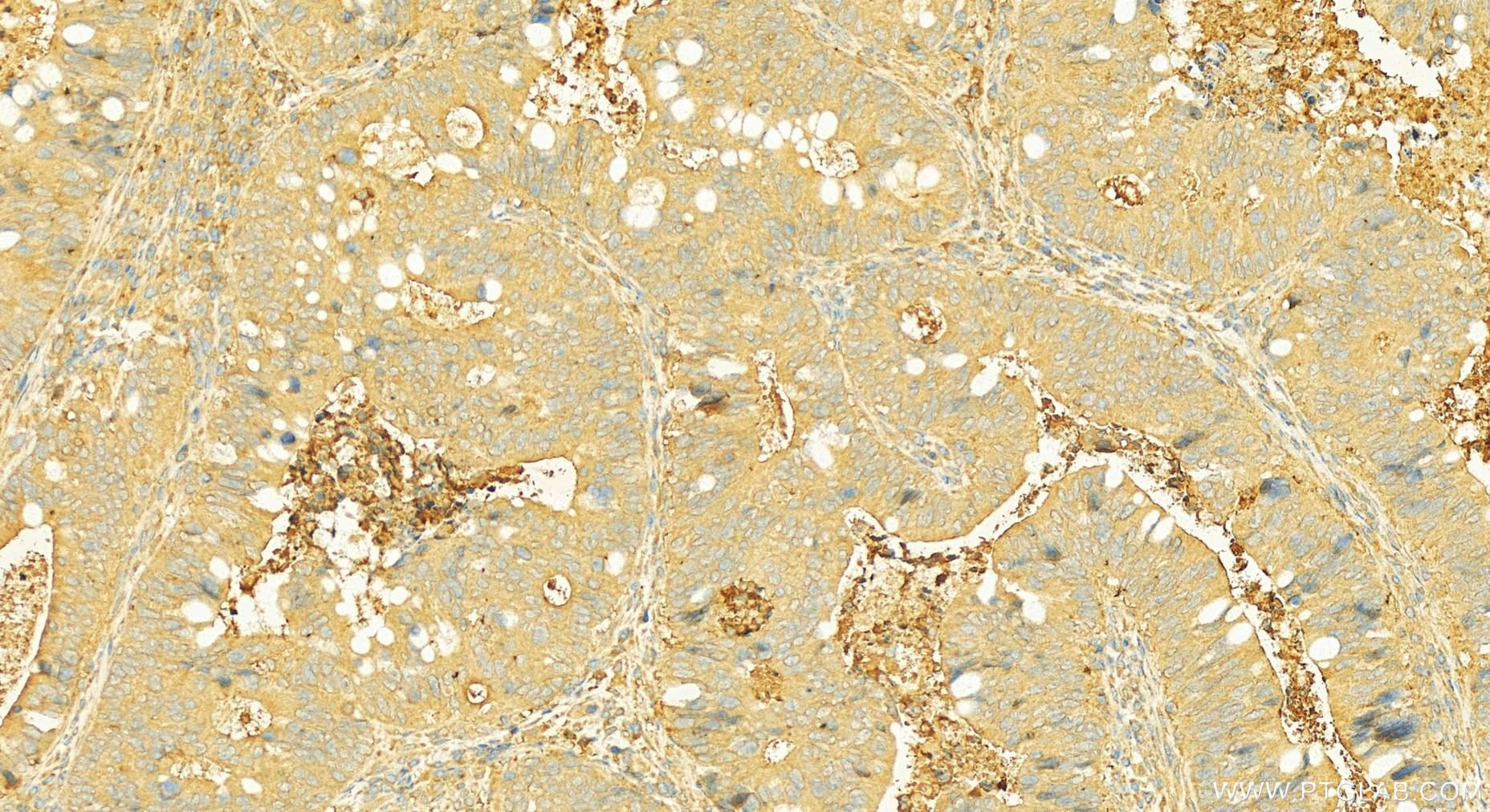 IHC staining of human colon cancer using 24640-1-AP