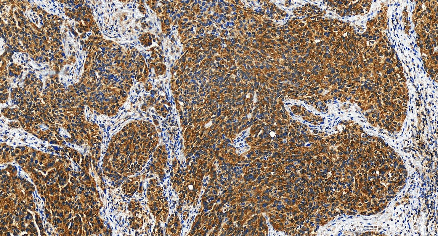 IHC staining of human ovary cancer using 28702-1-AP