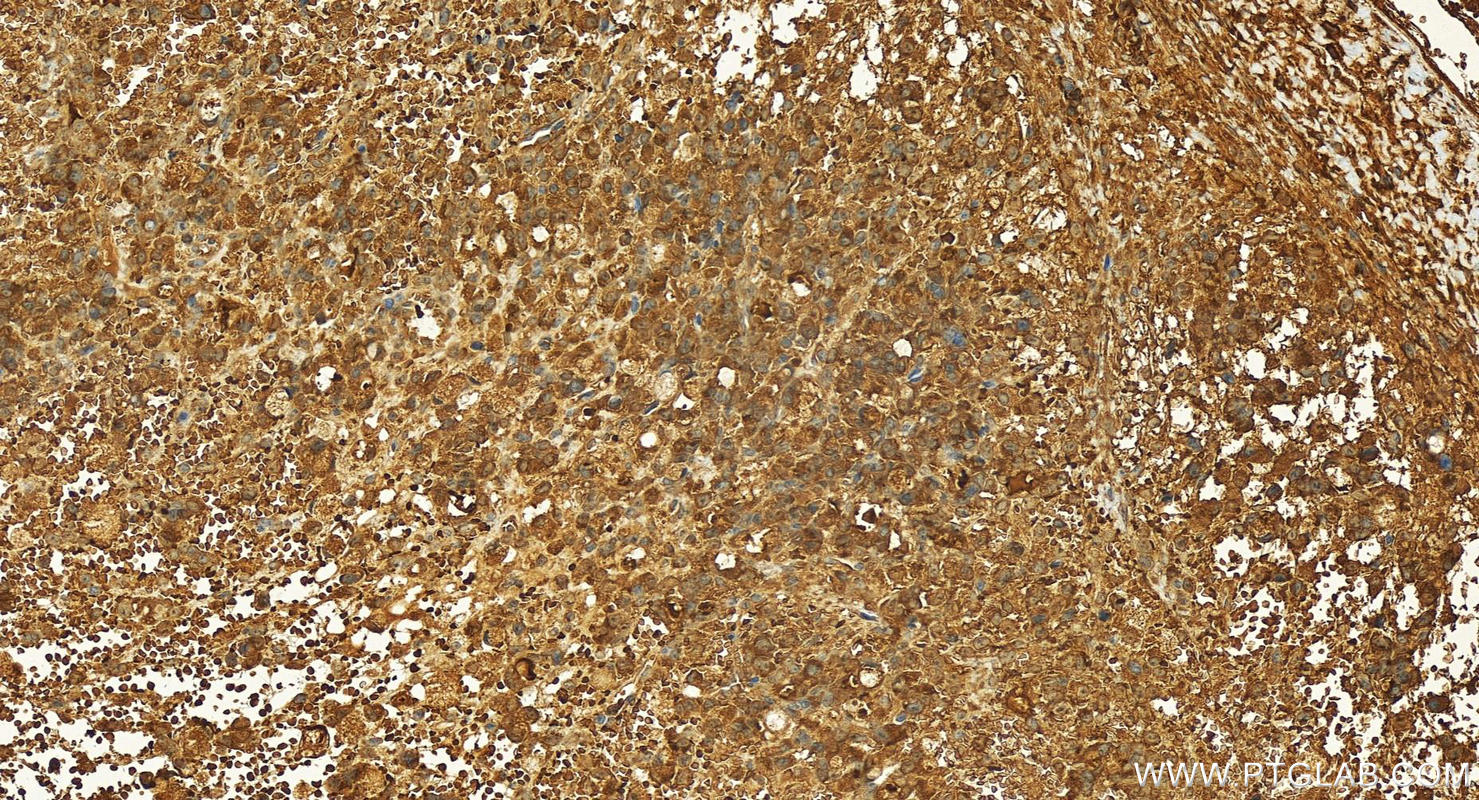 IHC staining of human ovary cancer using 17184-1-AP