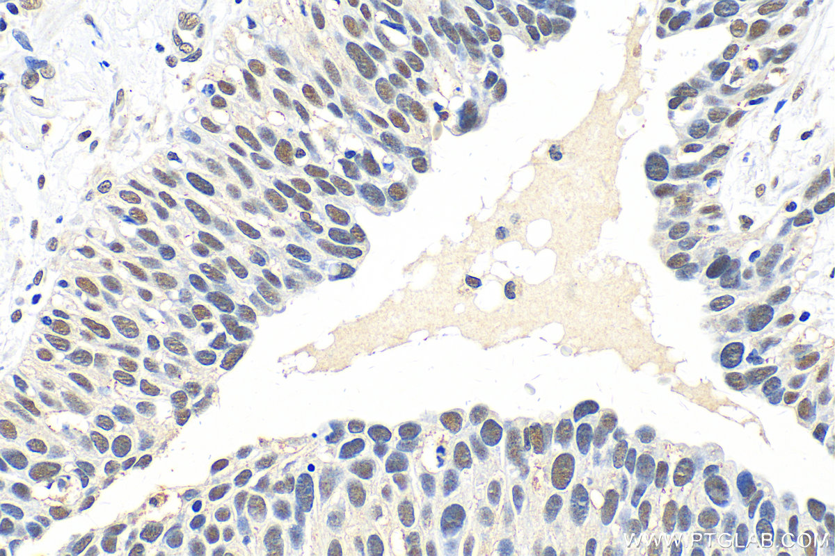 IHC staining of human lung cancer using 29314-1-AP