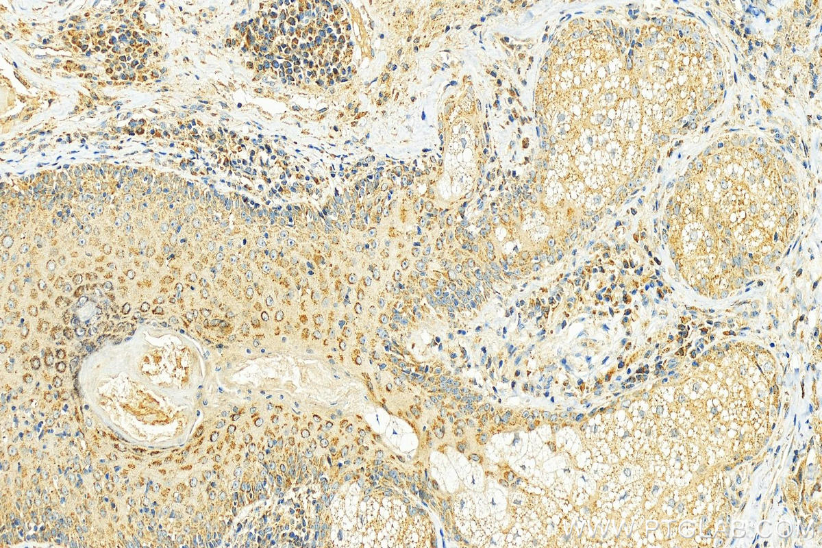 IHC staining of human skin cancer using 25951-1-AP