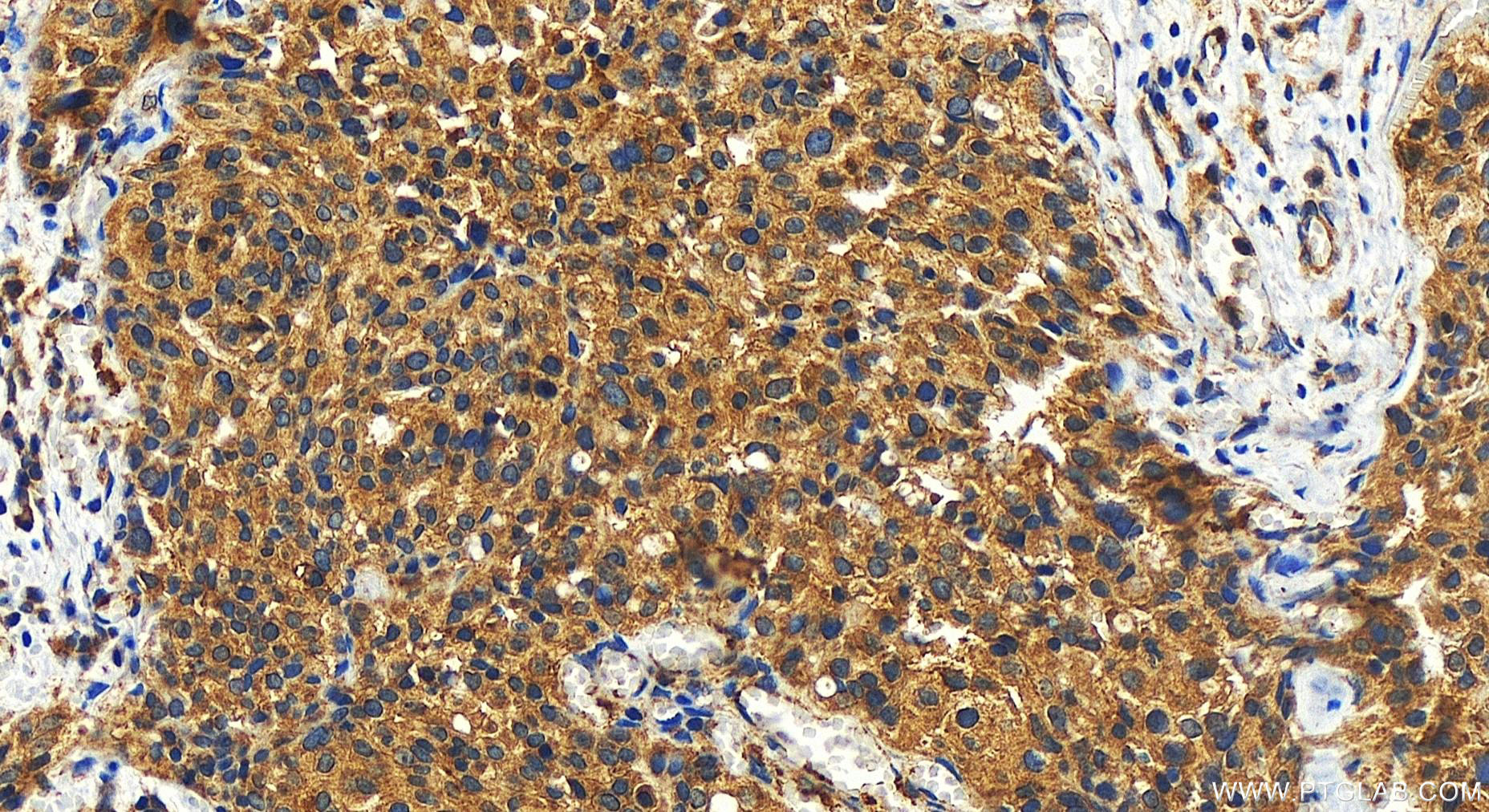 IHC staining of human ovary cancer using 10428-1-AP