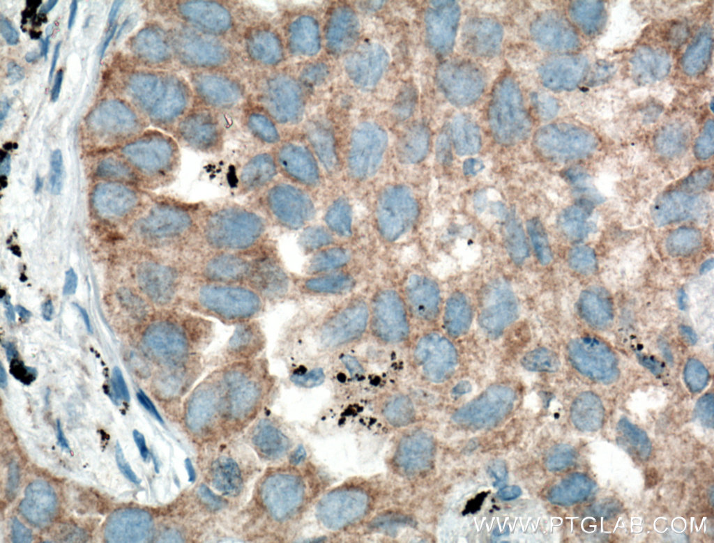 IHC staining of human lung cancer using 11285-1-AP