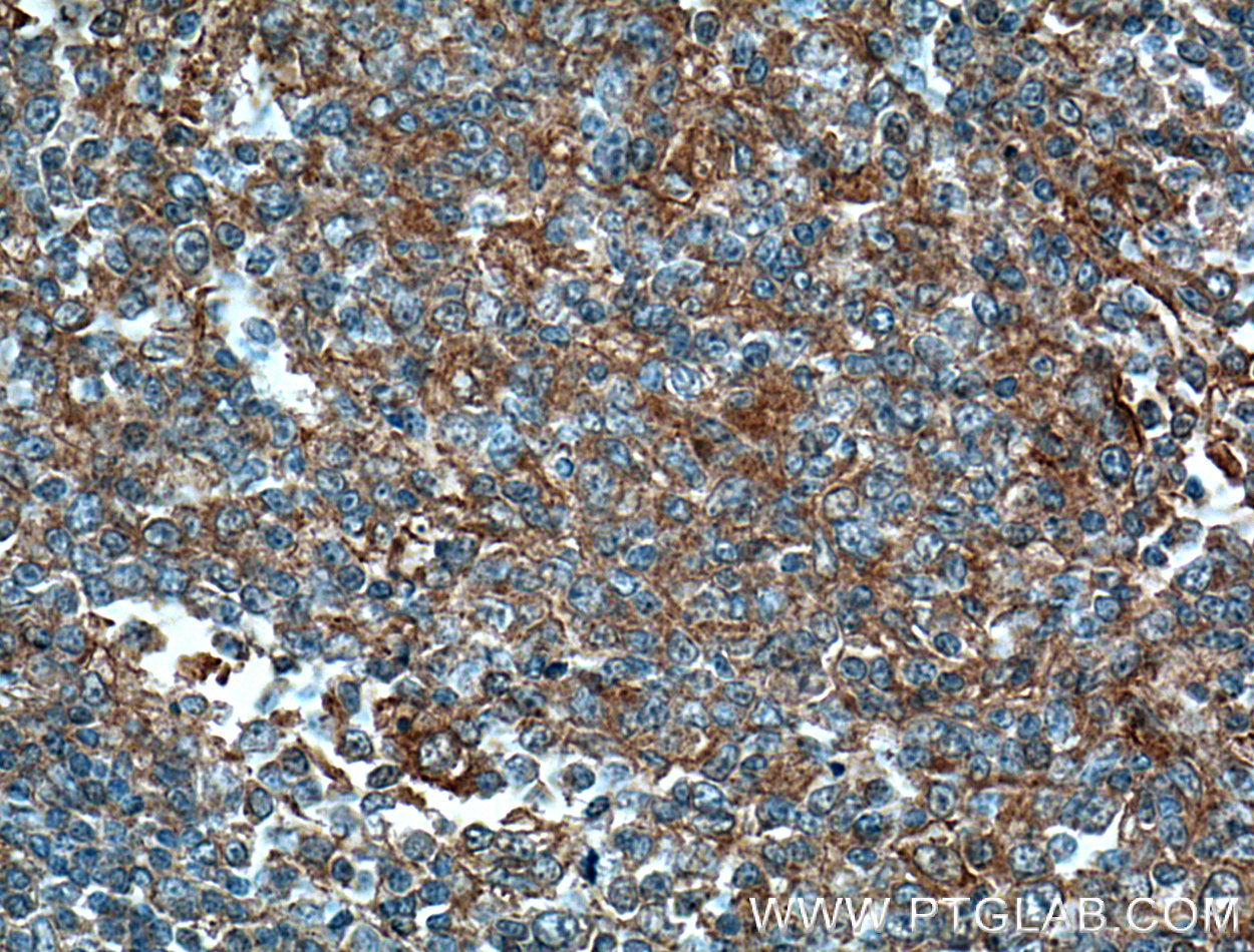 IHC staining of human tonsillitis using 66384-1-Ig (same clone as 66384-1-PBS)