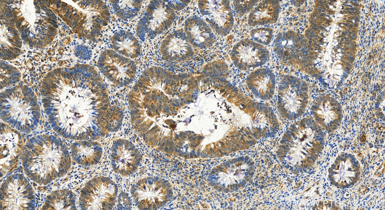 IHC staining of human colon cancer using 14325-1-AP