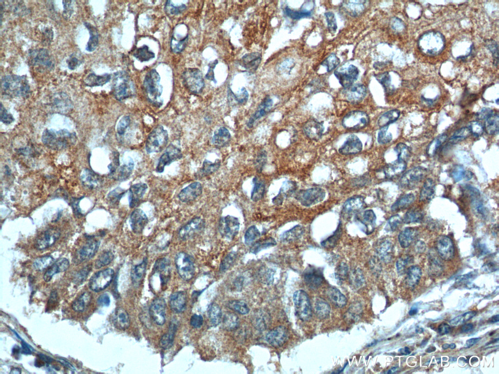 IHC staining of human lung cancer using 26527-1-AP