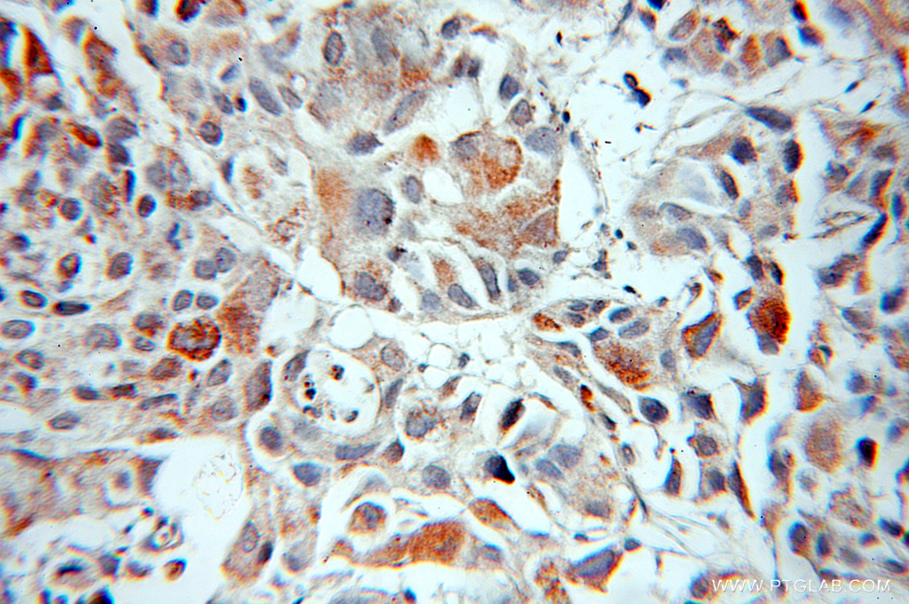 IHC staining of human prostate cancer using 11002-1-AP