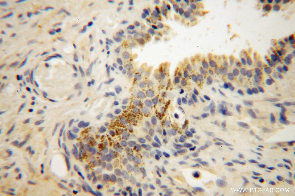 IHC staining of human gliomas using 14735-1-AP