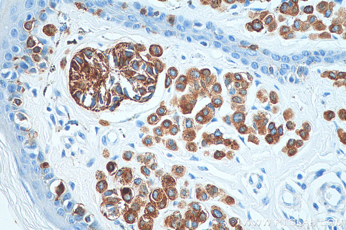 IHC staining of human malignant melanoma using 18472-1-AP