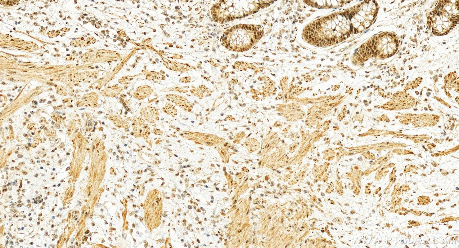 IHC staining of human colon cancer using 13100-1-AP