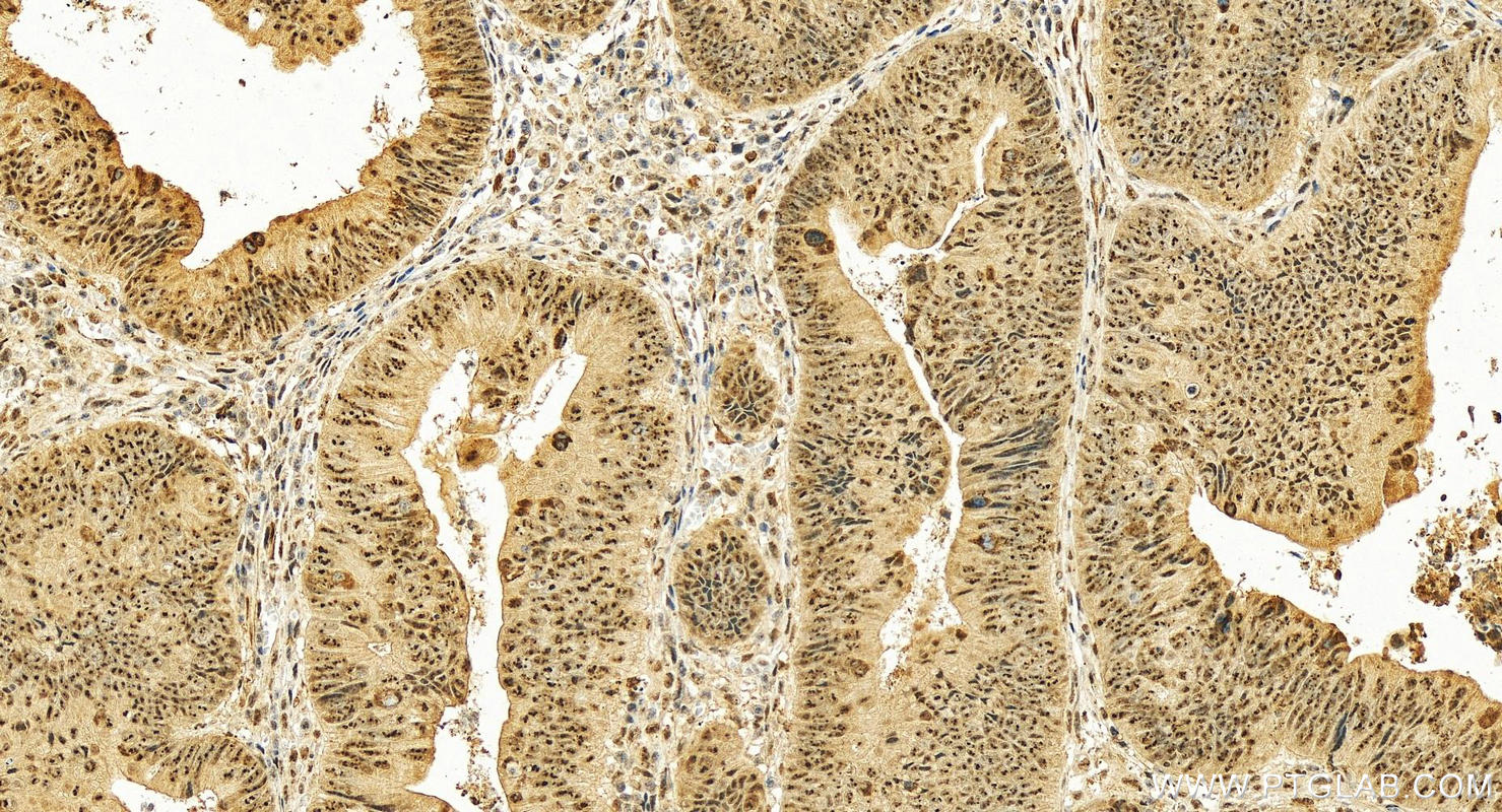 IHC staining of human colon cancer using 13100-1-AP