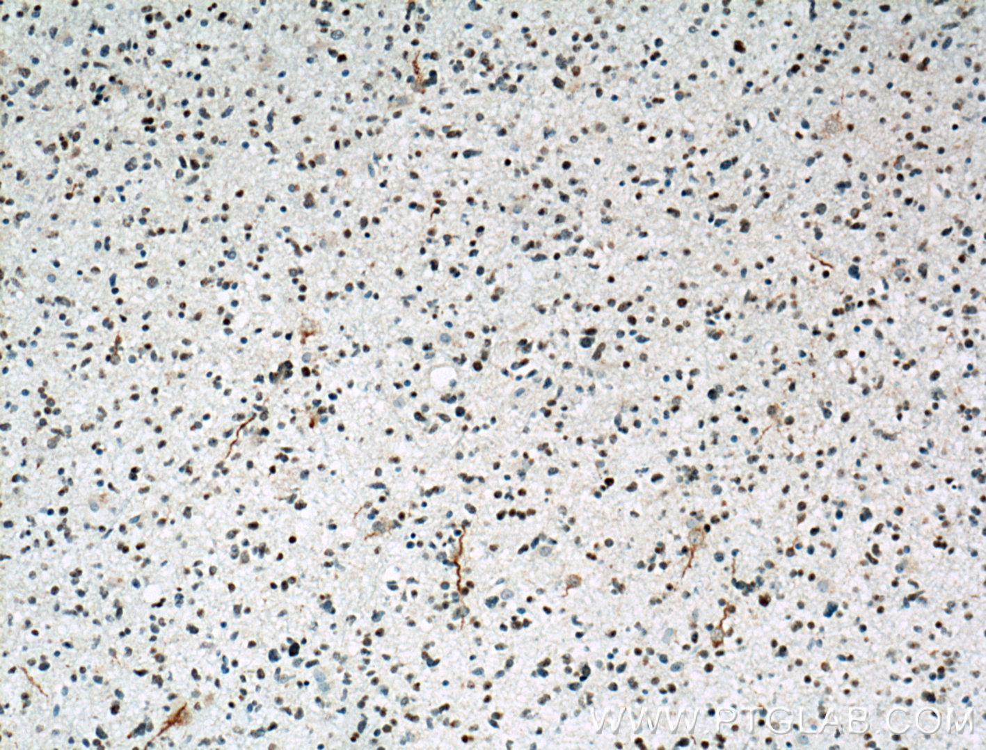 IHC staining of human gliomas using 11835-1-AP