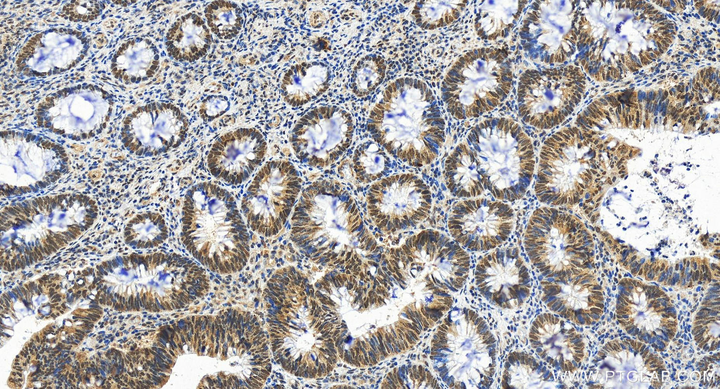 IHC staining of human colon cancer using 84208-2-RR (same clone as 84208-2-PBS)