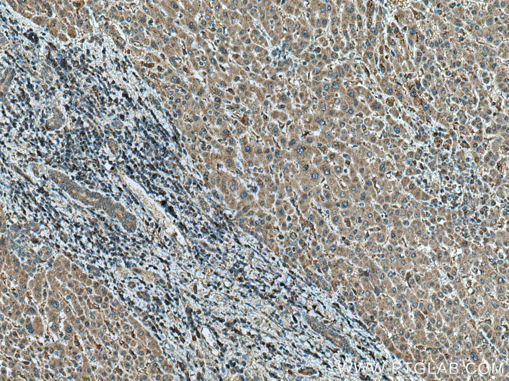 IHC staining of human liver cancer using 66675-1-Ig (same clone as 66675-1-PBS)