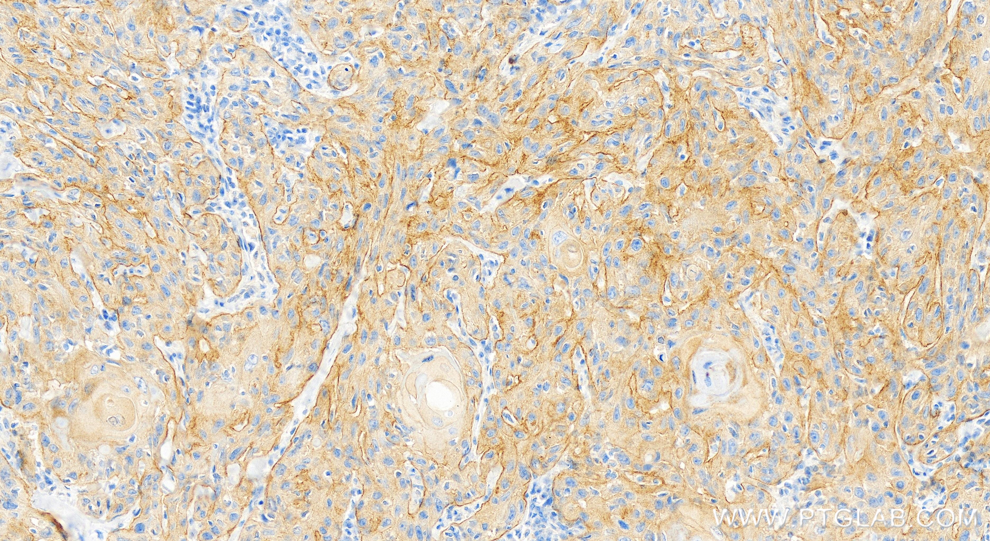 IHC staining of human skin cancer using 84282-1-RR