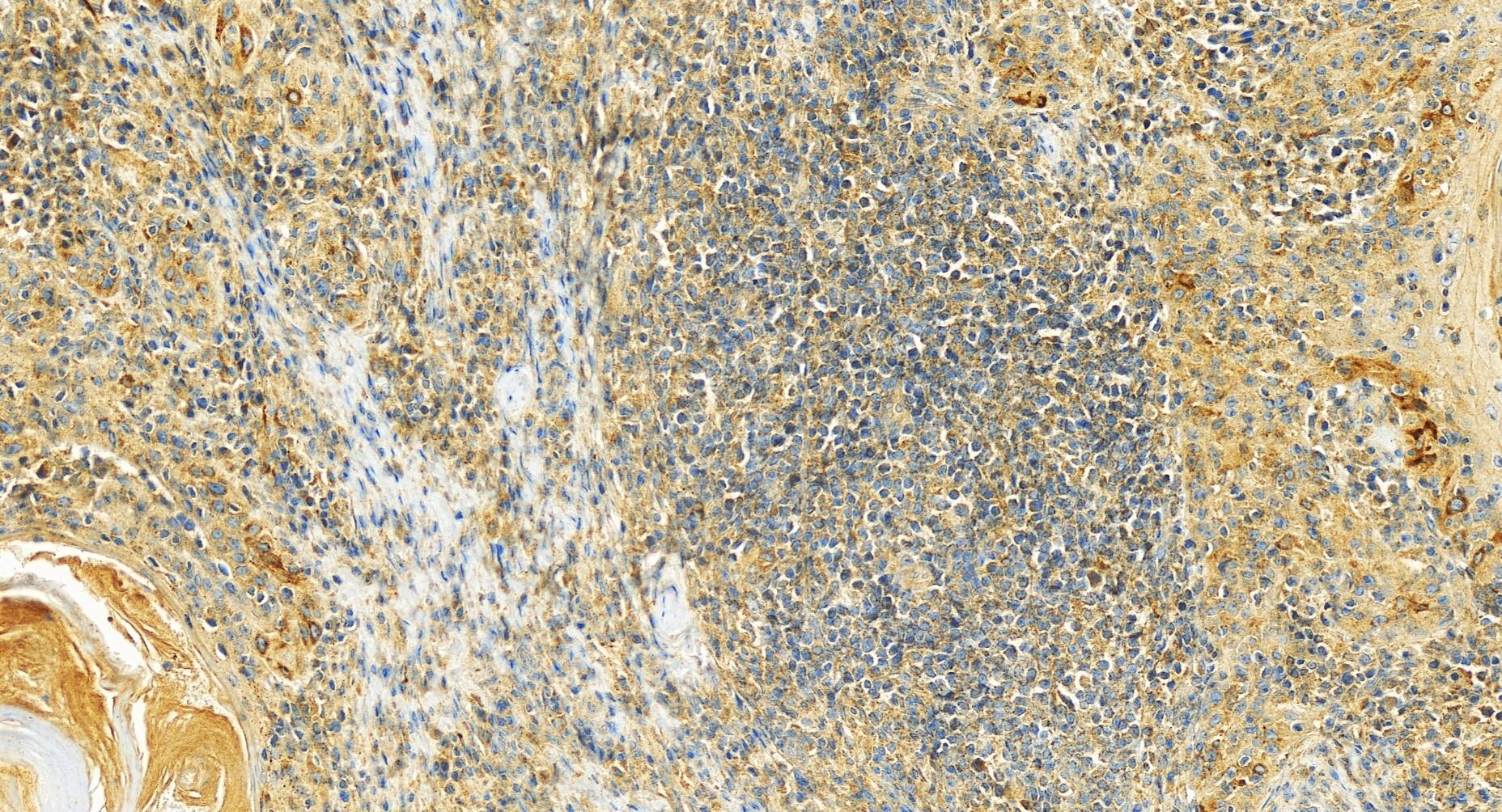 IHC staining of human skin cancer using 10371-2-AP